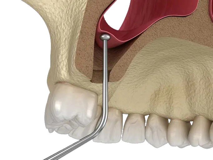 Sinus lift — podizanje poda sinusa i ugradnja koštanog materijala, Beograd